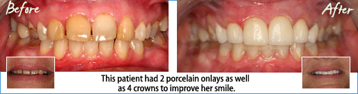 New Smile - Dr. Leardi Smile Gallery