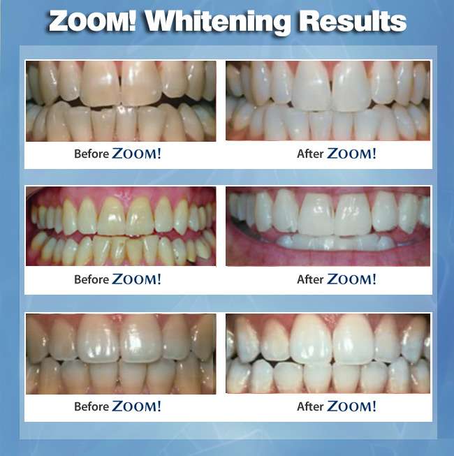 zoom-whitening